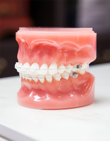 What Are Porcelain Ceramic Braces Image