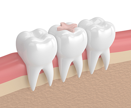 Dental Inlays Long Beach CA