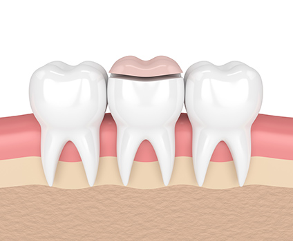 Dental Onlays  Long Beach CA