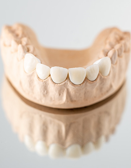CEREC Single-Visit Crowns, Bridges, Inlays, and Onlays Image